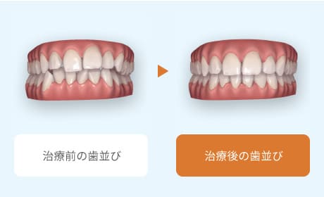 治療前の歯並び、治療後の歯並び